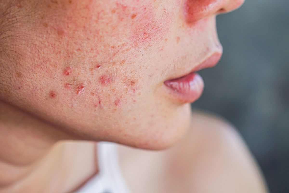acne e punti neri: usa il succo di pomodoro